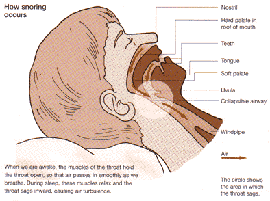 Mandibular Advancement Device