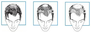 Hair loss signs diagram