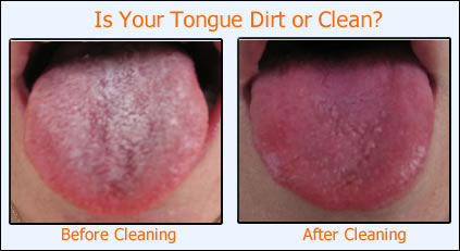 How dirty is your tongue