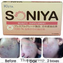 2 Soniya Kista Beauty Supplement Reduce Acne Pimpl